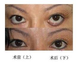 睑外翻矫正术
