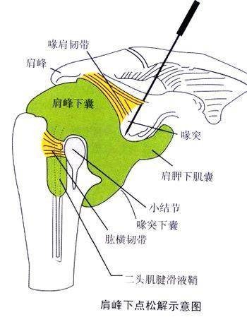 绿色微创激光针刀松解术
