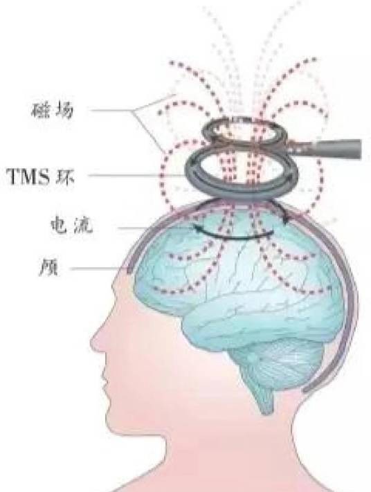 经颅磁刺激技术