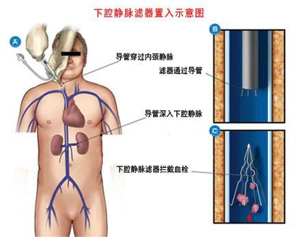 经皮放置静脉滤器
