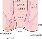 藏毛性疾病